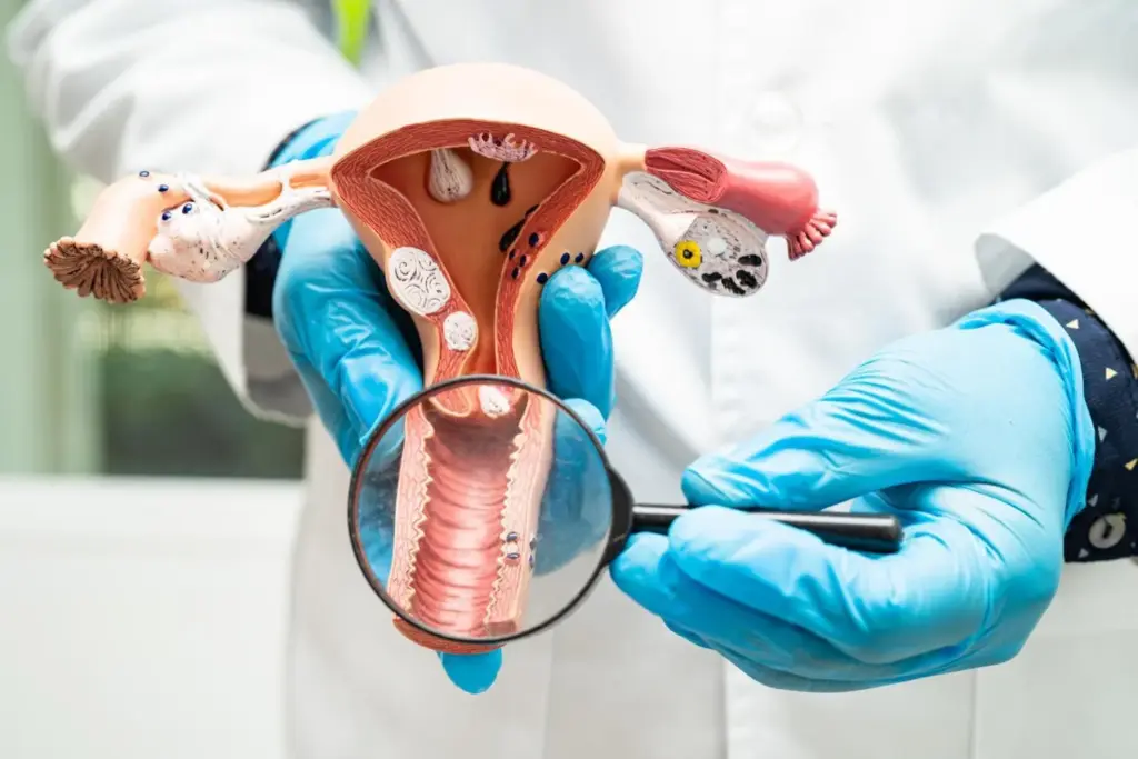 Stage 1 Ovarian Cancer Symptoms: Amazing Info 7 SEP 15569 image 7 LIV Hospital