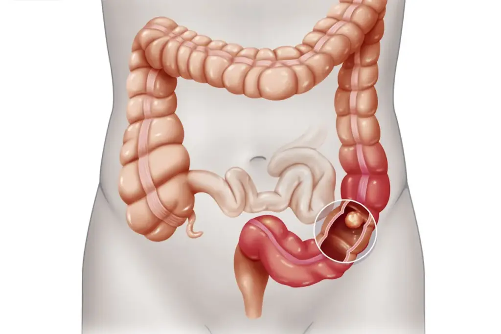 Small Bowel Obstruction Icd 10: Amazing Facts 3 SEP 15813 image 3 LIV Hospital