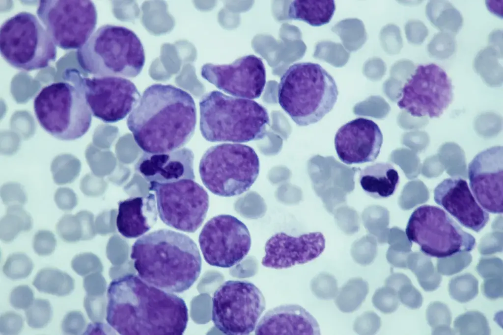 Leukemia Diagnosis: Amazing Scary Mimic Facts