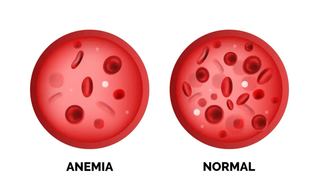 What Is Thalassemia?