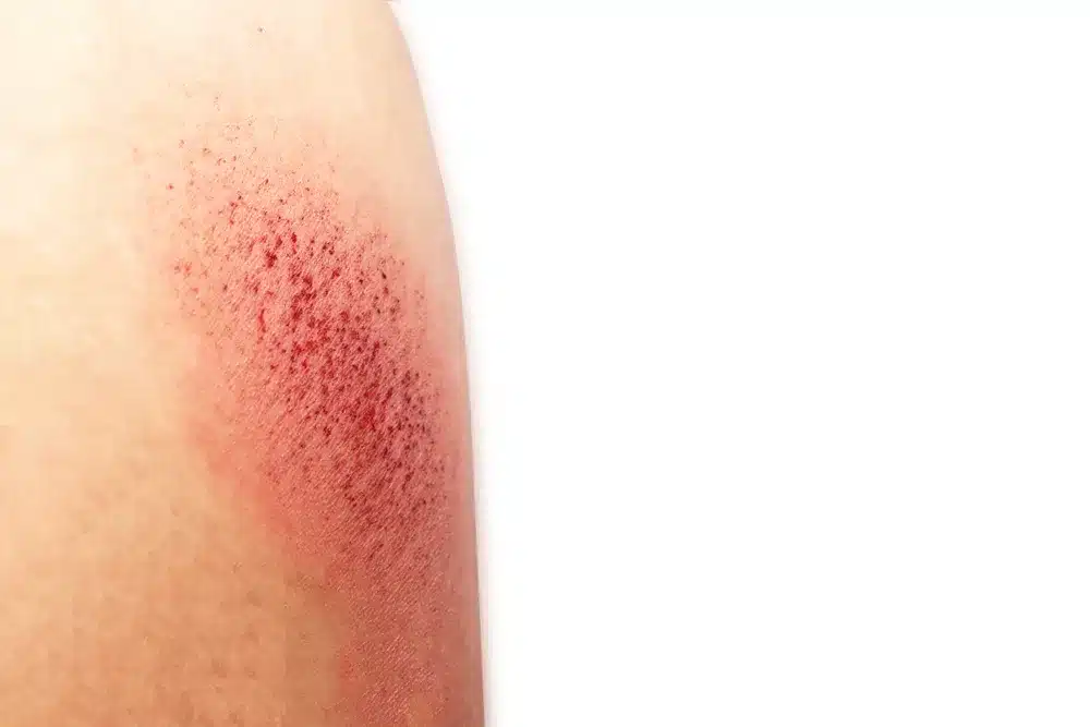 Petechiae Warning: The Scary Truth Of Red Spots