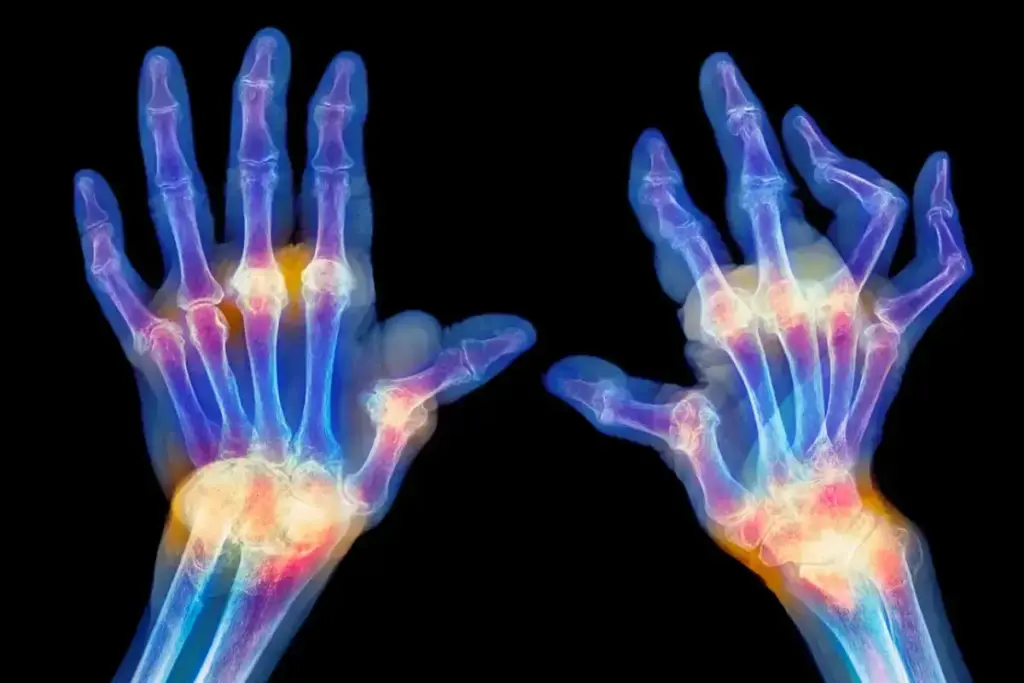 Rheumatoid Arthritis: An Autoimmune Challenge