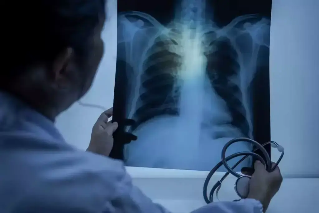 The Rising Concern of Lung Cancer in Never-Smokers