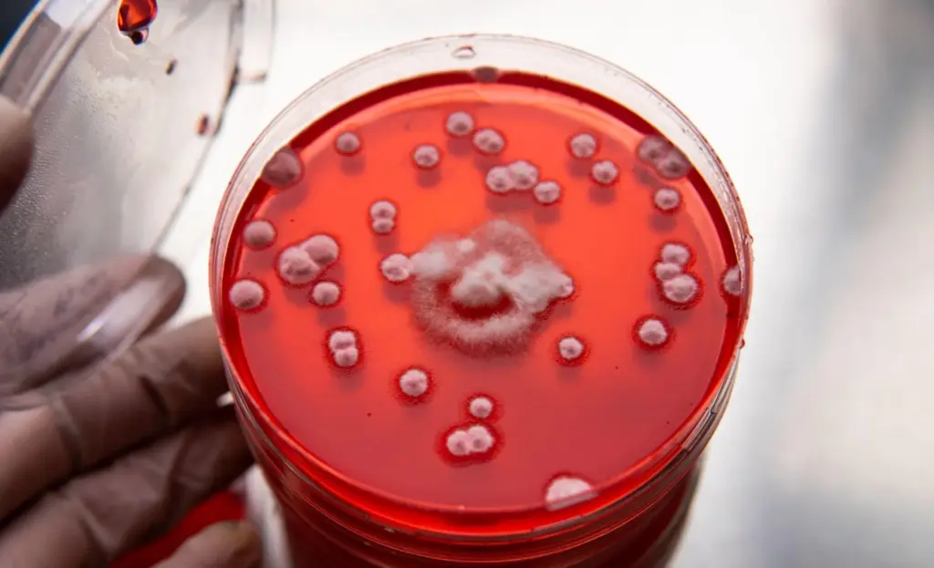 Types of Diseases That Cause Anemia Through Red Blood Cell Destruction