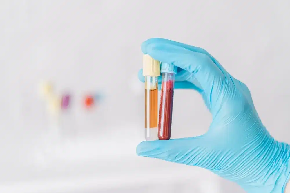 Is Hemophilia Recessive? Exploring the X-Linked Inheritance Pattern