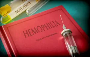 Hemophilia A Rules: Can Fathers Pass It On?