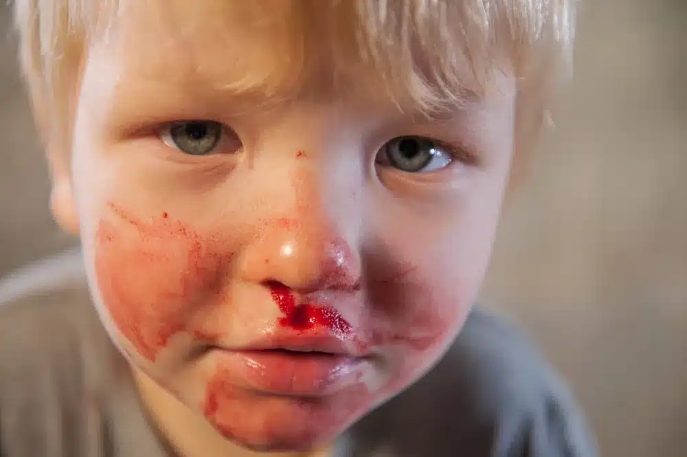 Definition Of Hemophilia Disease: Daily Impacts 5 Hemophilia in Children: Unique Challenges