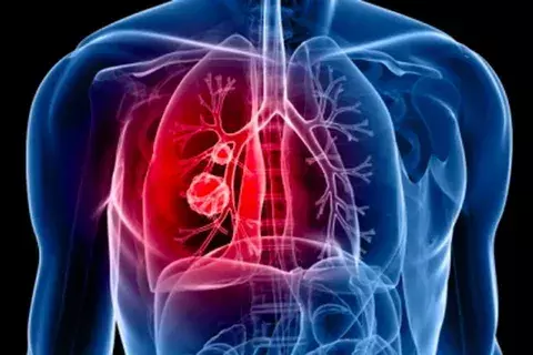 The Connection Between Asbestos and Cancer