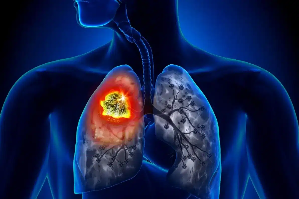 What Causes Lung Cancer in Non-Smokers? Genetic and Environmental Factors Explained