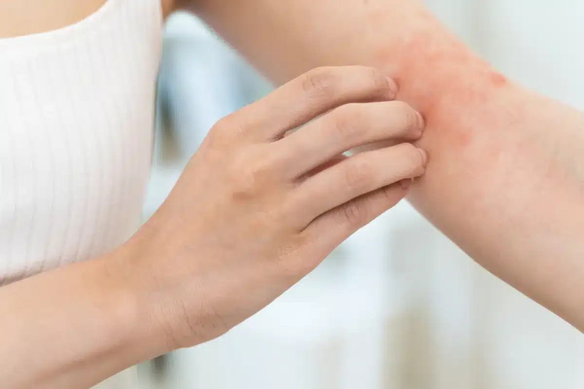 How to Relieve Allergic Reactions: Quick Treatment Guide