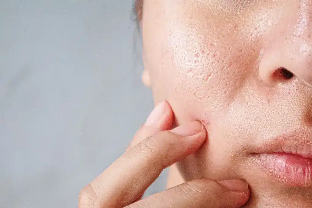 5 Stages of Allergic Reaction: A Complete Guide