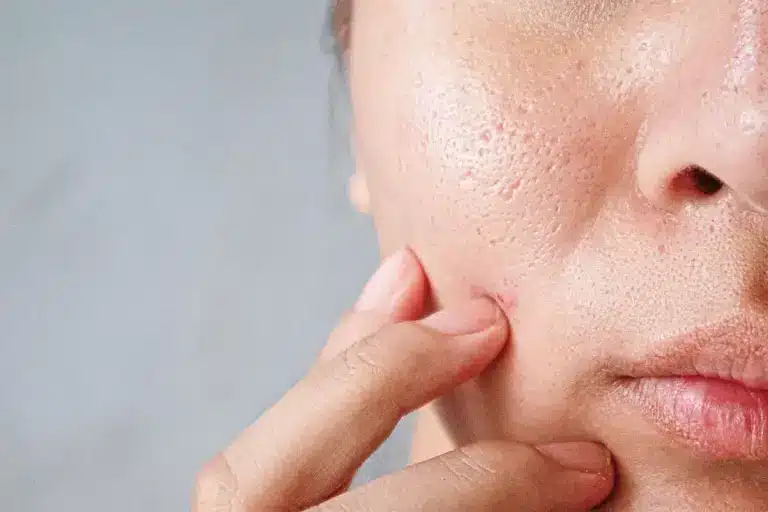 5 Stages of Allergic Reaction: A Complete Guide