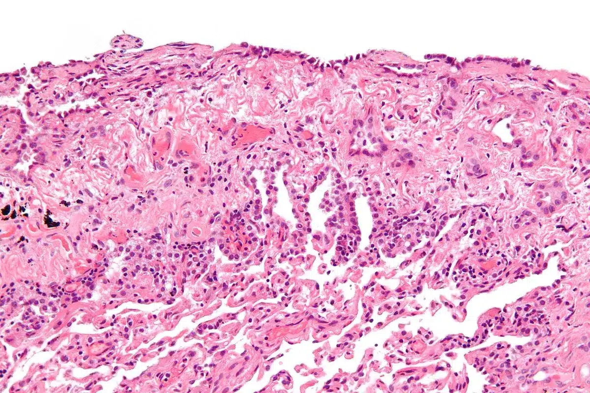 5 Key Facts About Epithelioid Mesothelioma Cancer
