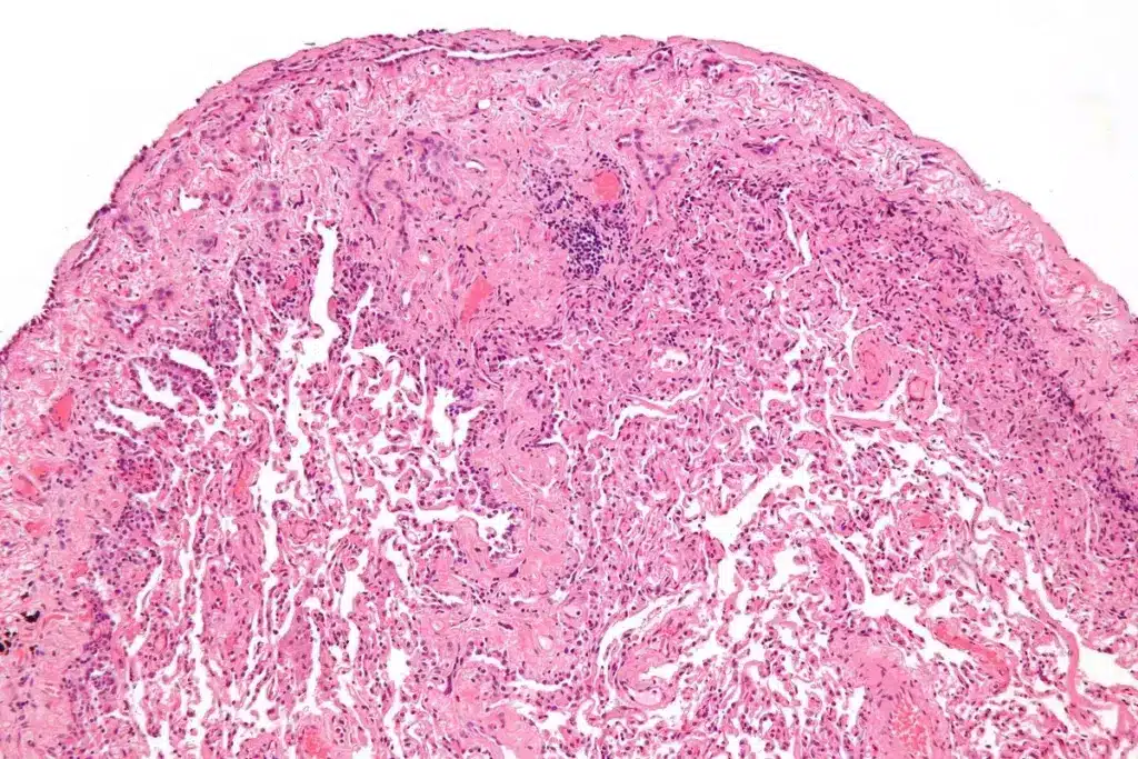 Understanding Epithelioid Mesothelioma Cancer: Prevalence and Causes