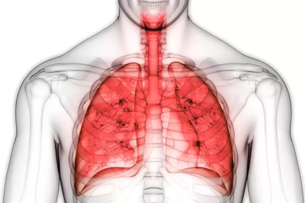 What Causes Bronchial Wall Thickening and What Does It Mean? 2 Understanding Bronchial Wall Thickening
