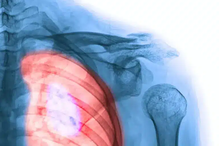 Is Interstitial Lung Disease Curable? Treatment Options Explained