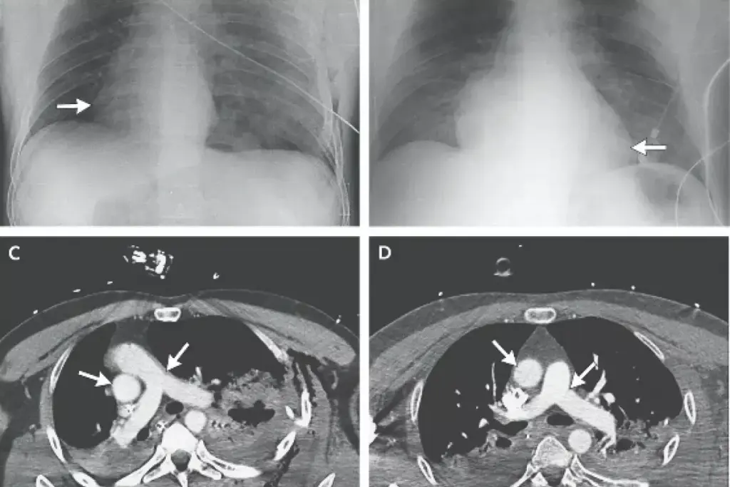 Bronchitis Lack of Appetite and Digestive Symptoms