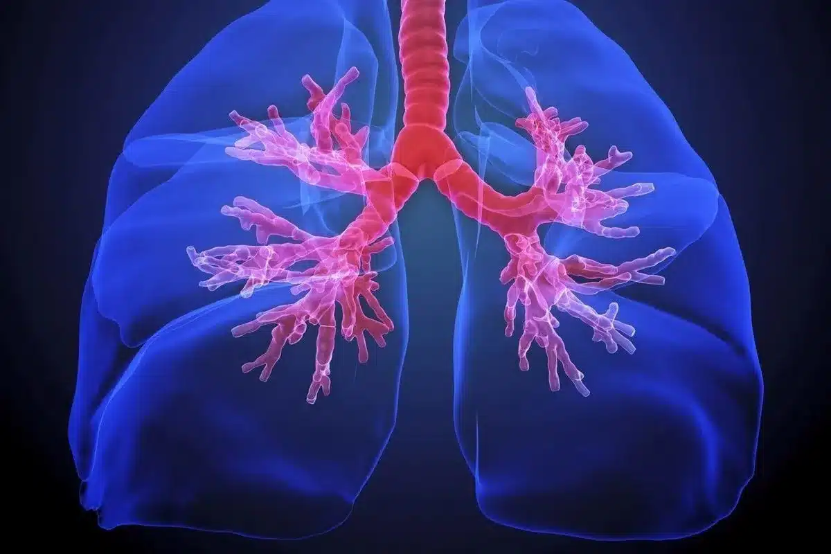 Is Bronchiectasis Obstructive or Restrictive? Understanding Lung Disease Classification