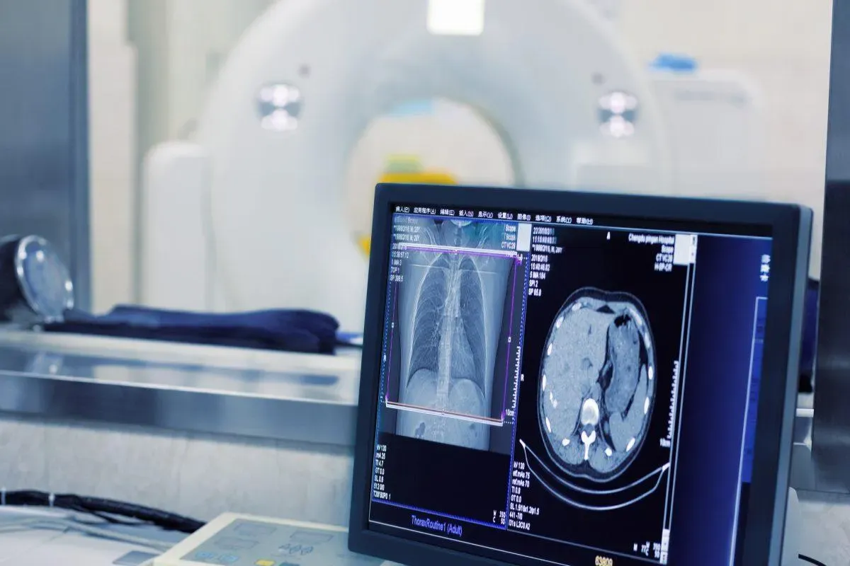 Types of Bronchiectasis: 3 Classifications on CT and X-Ray