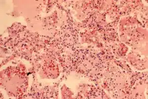 What's the Difference Between Bronchitis and Bronchiolitis?