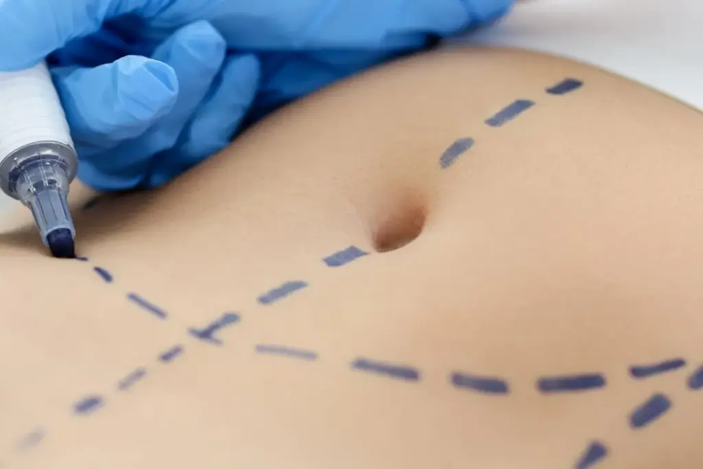 Hernia Surgery Recovery Time: Amazing Results