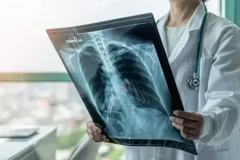 Does a Chest X-Ray Show Asthma? What You Need to Know 3 When Chest X-Rays Are Valuable in Asthma Management