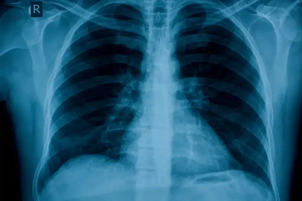What Causes Bronchial Wall Thickening and What Does It Mean? 1 What Causes Bronchial Wall Thickening and What Does It Mean?