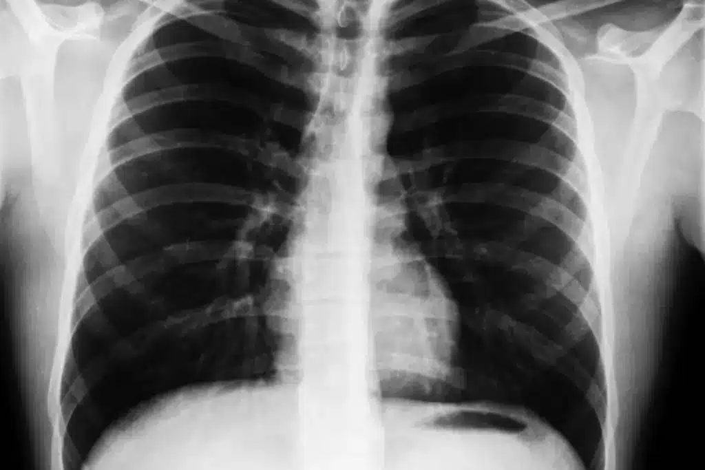 Does a Chest X-Ray Show Asthma? What You Need to Know 1 Does a Chest X-Ray Show Asthma? What You Need to Know