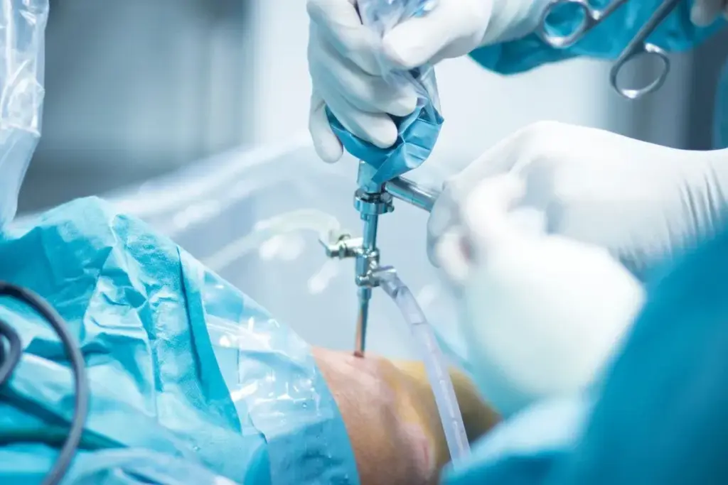 Arthroscopy Operation: Easy Recovery Guide
