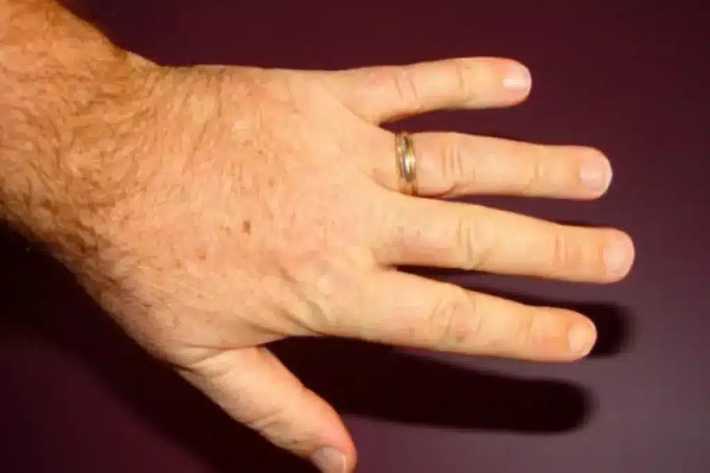 Immediate Post-Surgery Restrictions