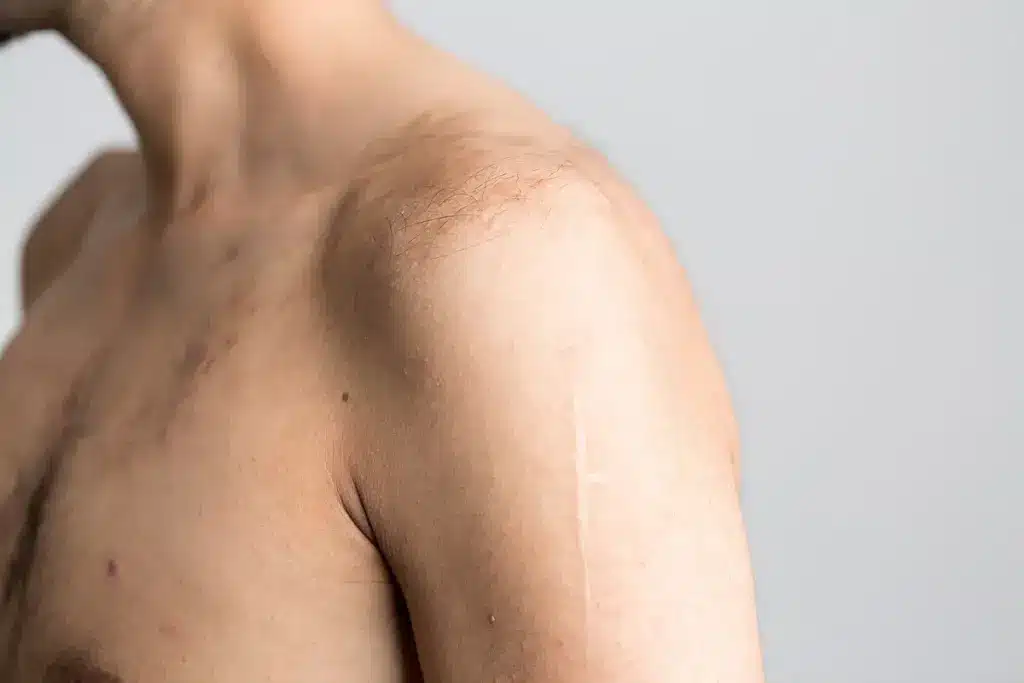 The Nature of Shoulder Tendonitis