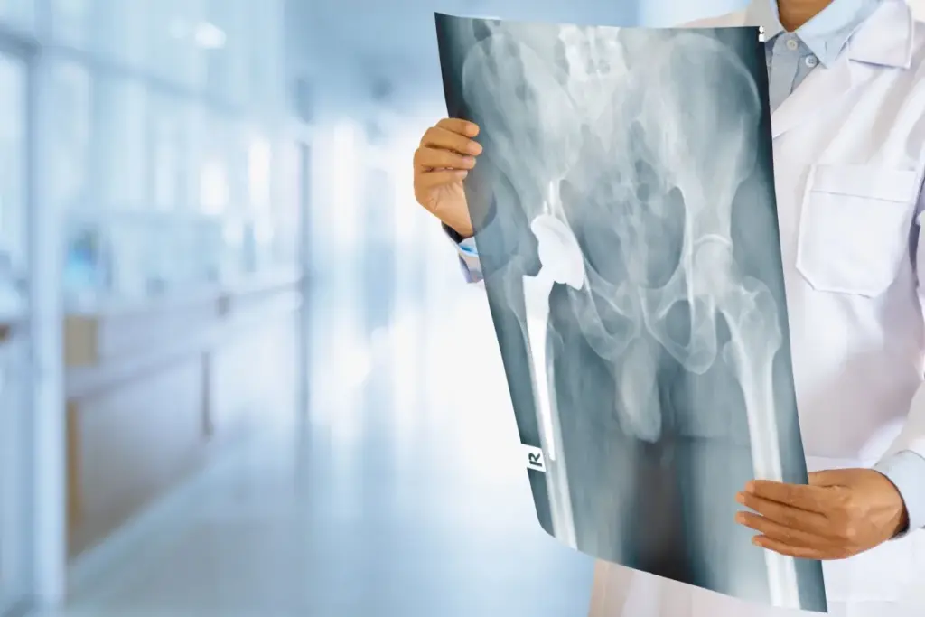 Hip Replacement Recovery Time: Hospital Guide