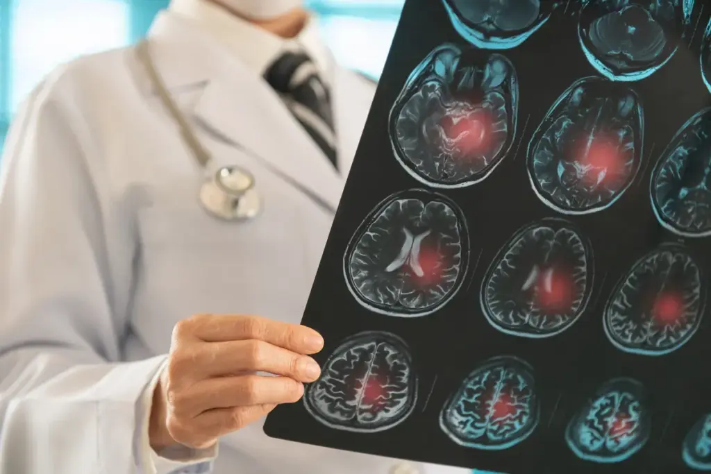 What Is an Aneurysm?