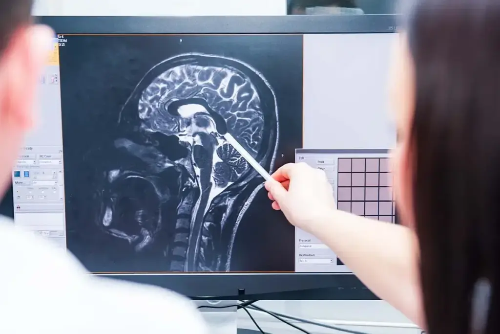 Avm: Amazing Facts On Rare Conditions