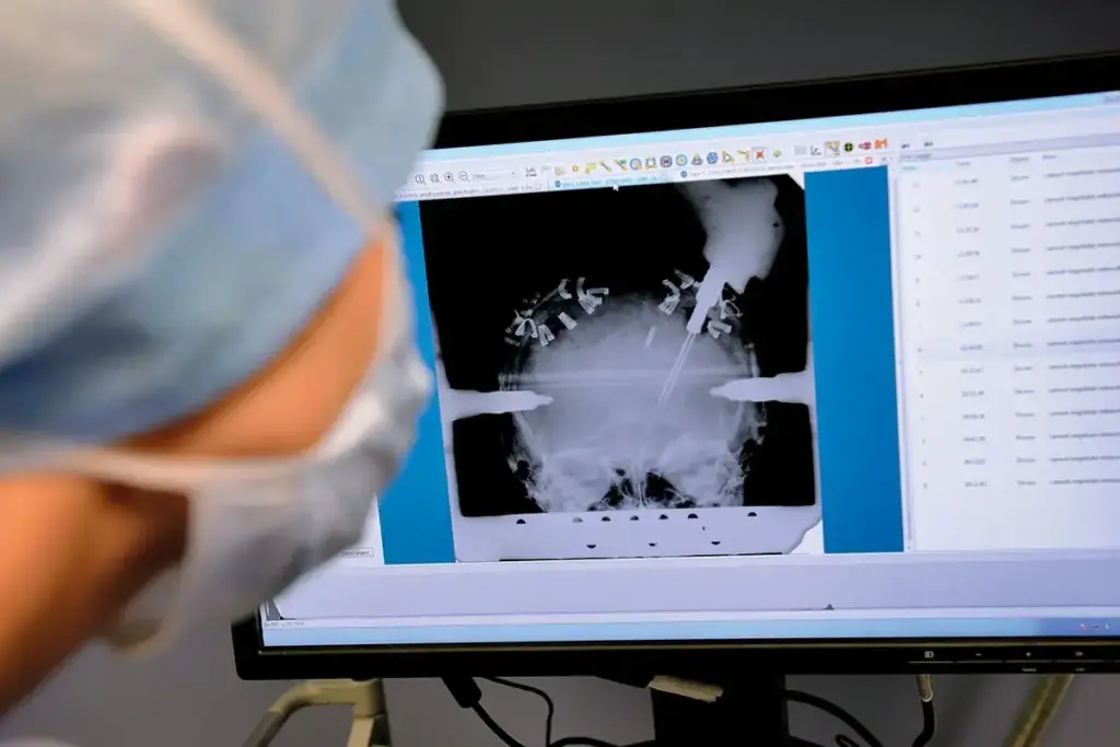 Chiari Malformation: Successful Long Life 2 Understanding Chiari Malformation Type1