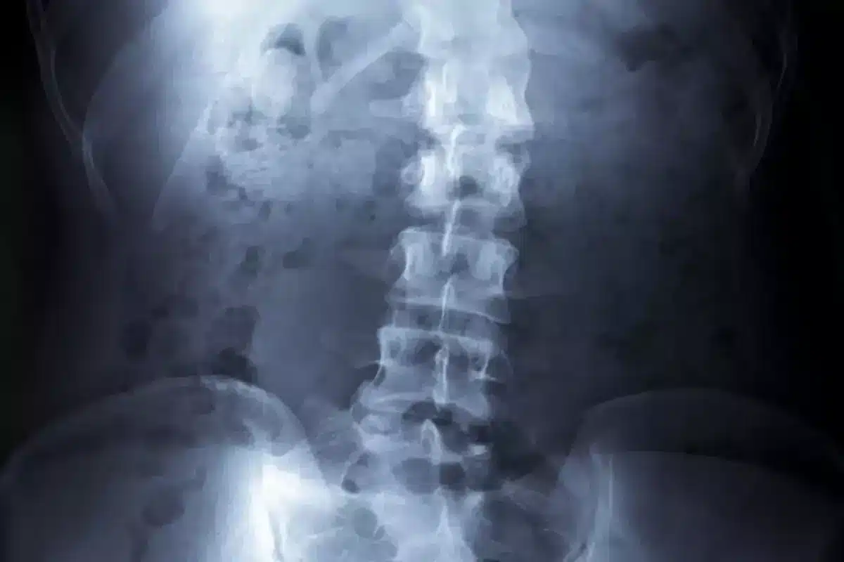 Can You Develop Scoliosis? Shocking Truth For Adults