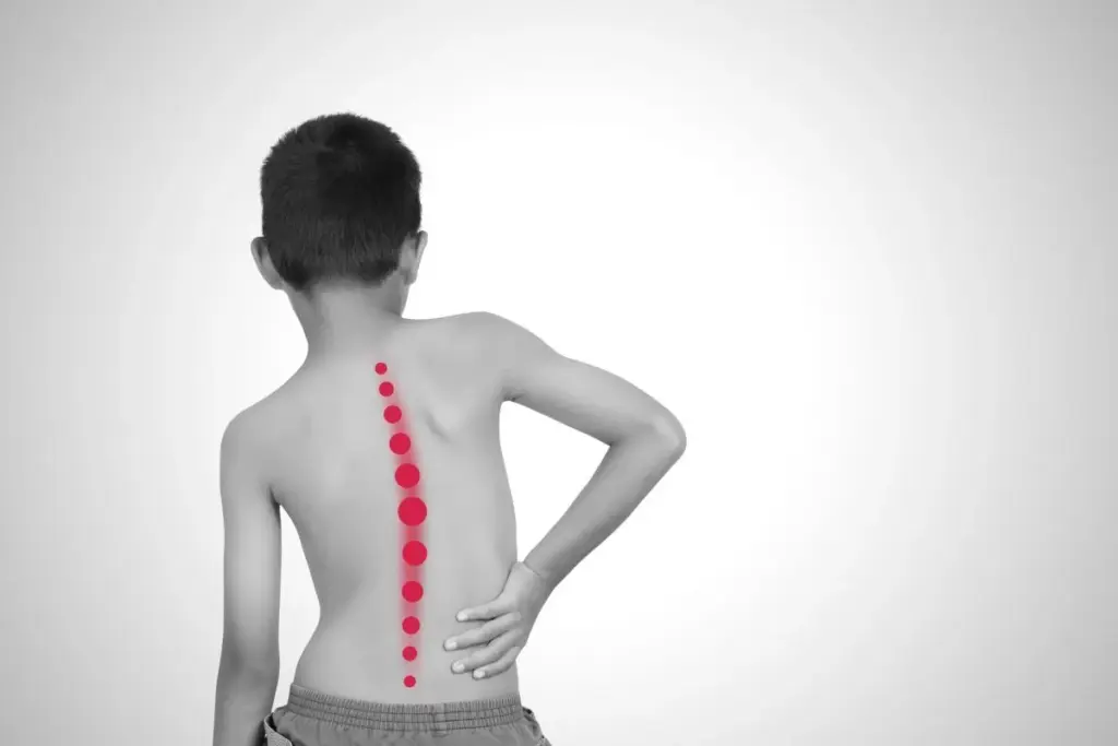 Scoliosis: The Critical Age For Early Detection 2 Understanding Scoliosis: Definition and Overview