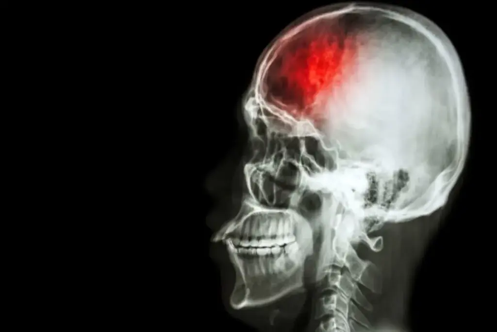 Craniotomy: Managing Scary Post Surgery Issues 3 Understanding Craniotomy and Its Purposes