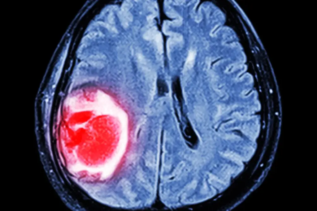 Understanding Brain Tumors: An Overview