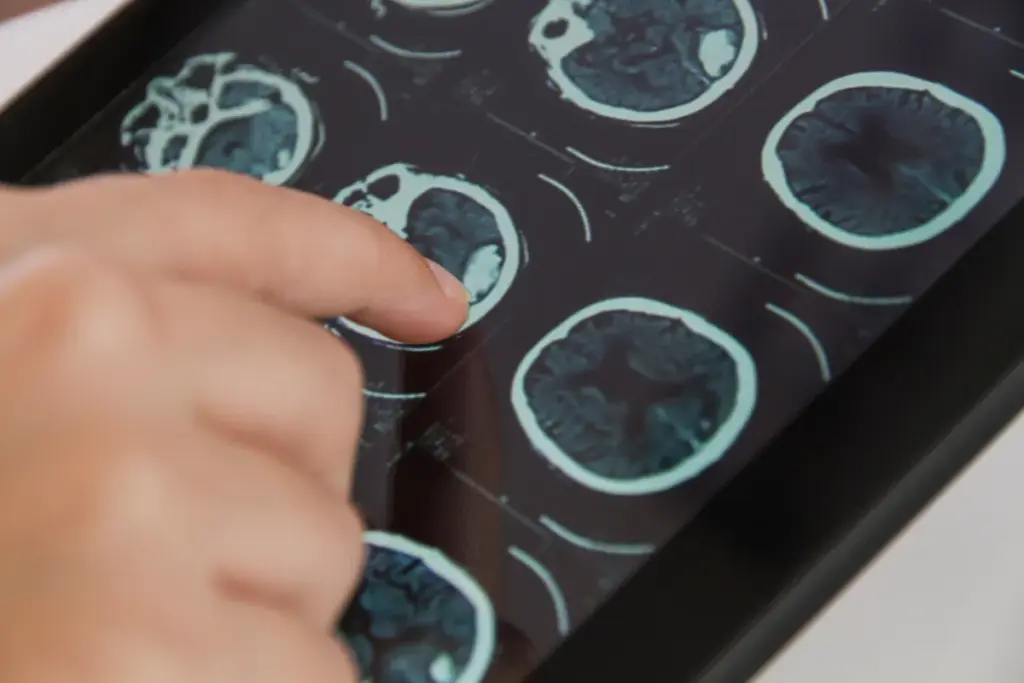 Understanding Epilepsy: When Medical Management Fails
