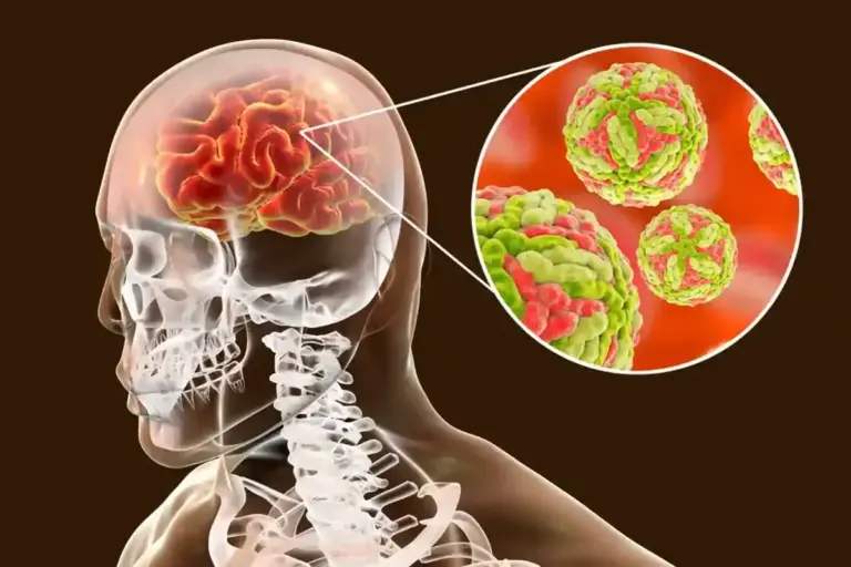 Hydrocephalus Meningitis: Elite Healing Secrets