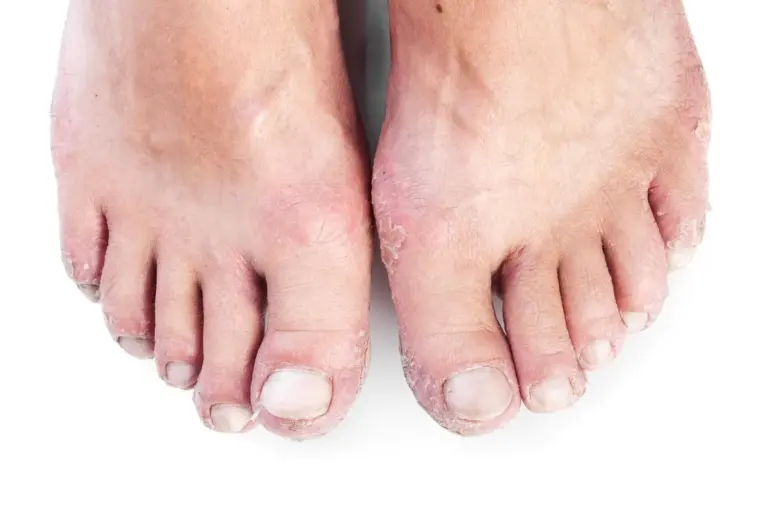 What Causes Itchy, Dry Skin with Diabetes?