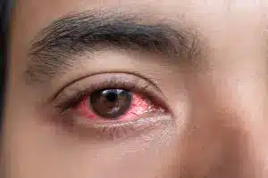 Can You Have Pink Eye Without Discharge? What You Need to Know