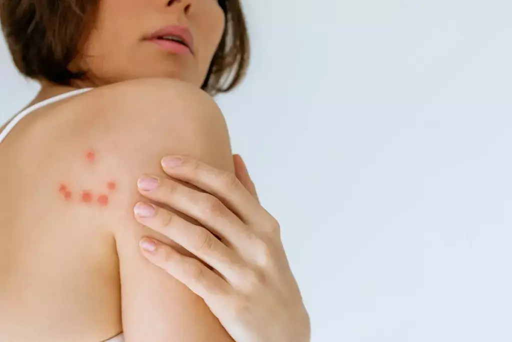 What Causes Hives on Skin