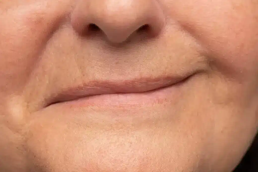 Common Causes of Unilateral Submandibular Swelling