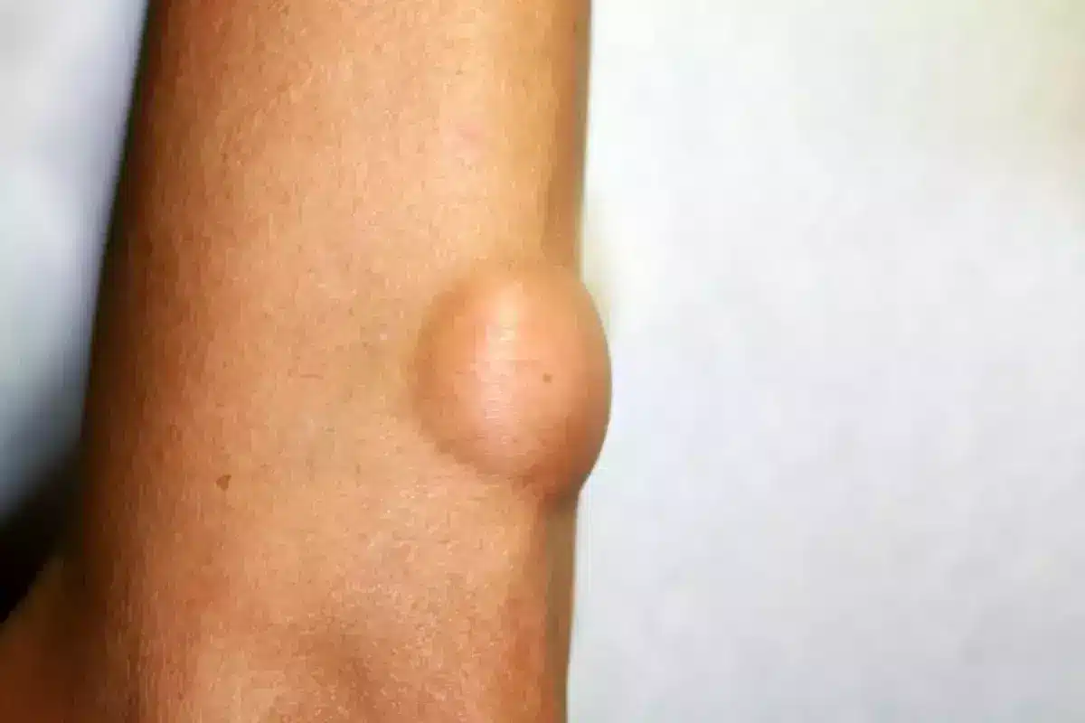 What Causes a Lump Under Your Chin and When Should You Worry?