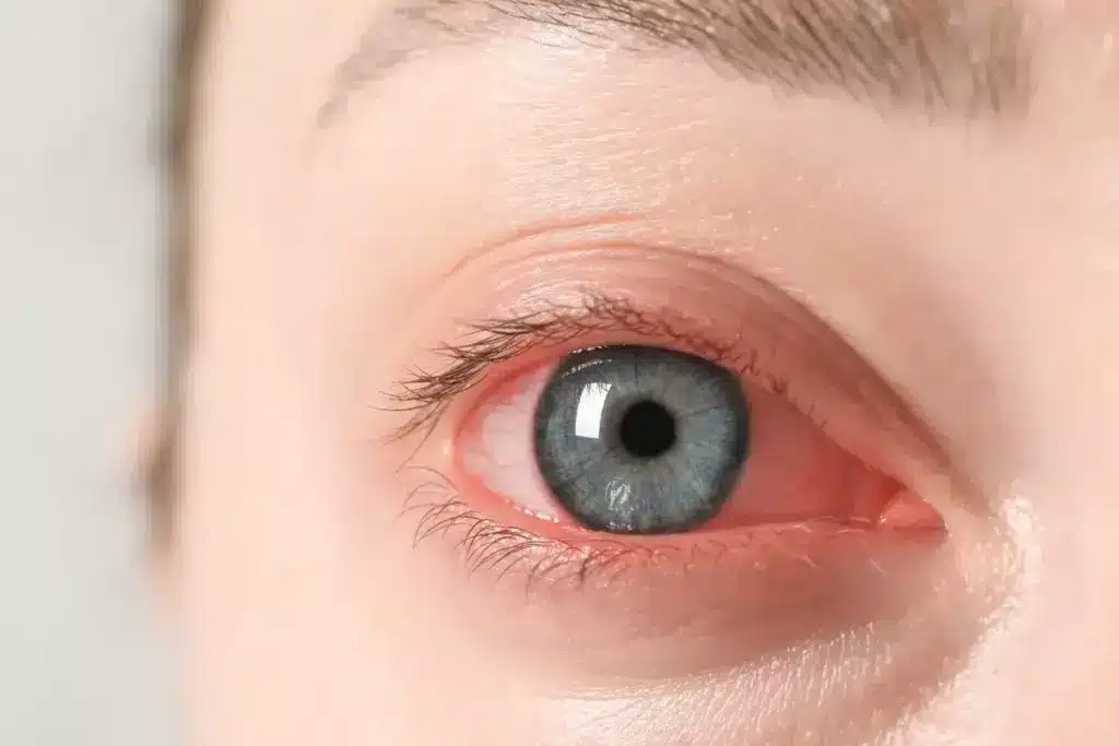 How to Relieve Red Eyes and Runny Nose 3 How to Relieve Red Eyes and Runny Nose