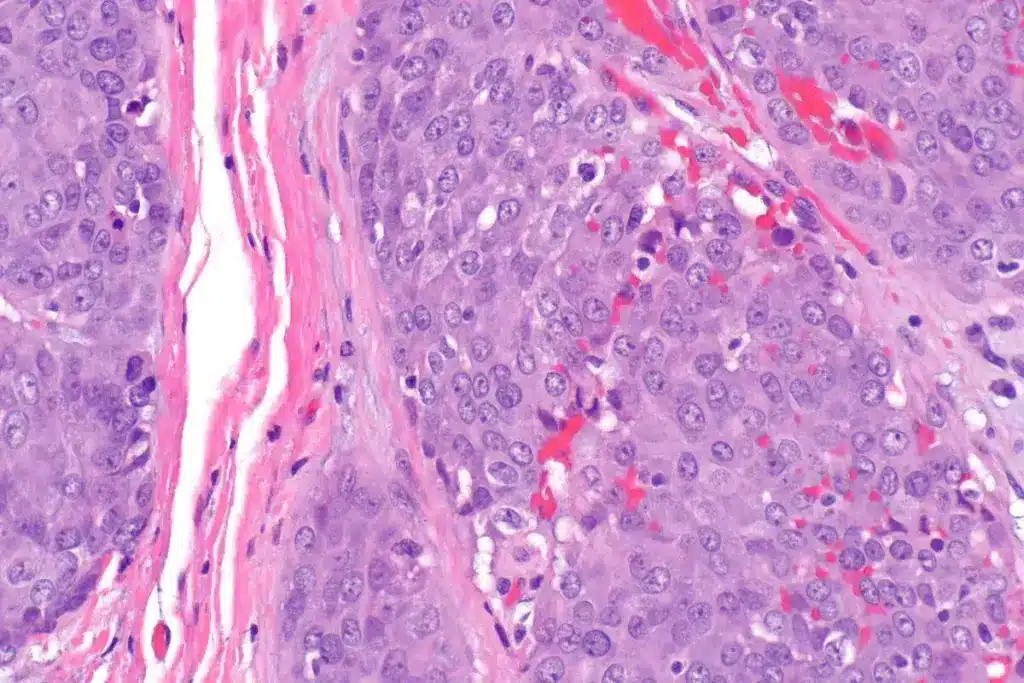 5 Key Facts About Submandibular Gland Cancer: Symptoms, Diagnosis & Treatment