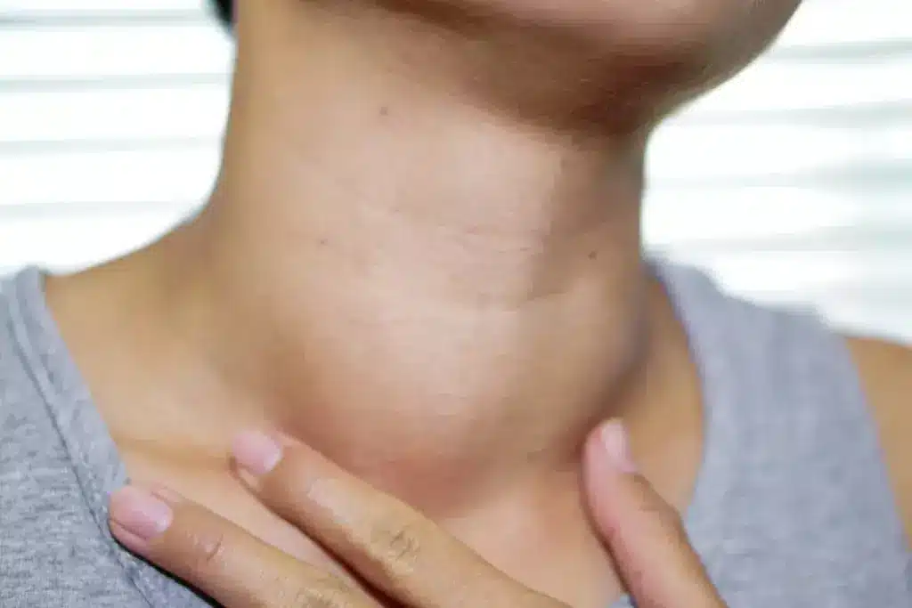 How to Treat Submandibular Gland Swelling