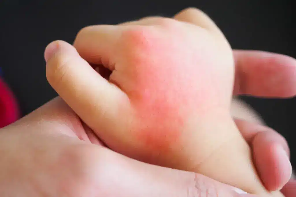 What Causes Swollen Hands and Rash All Over Body?
